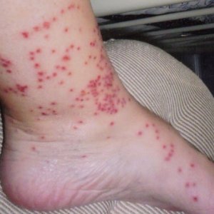 seed tick bites.jpg